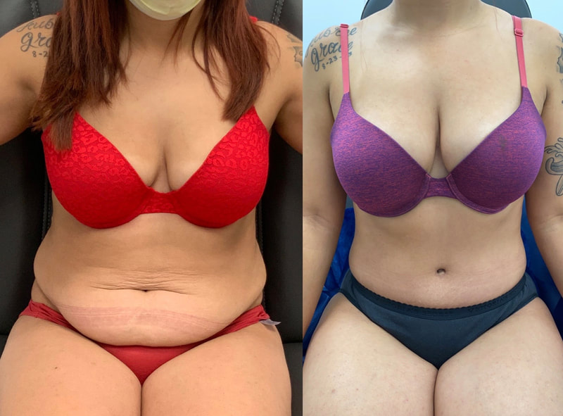 tummy tuck  - before & after 103