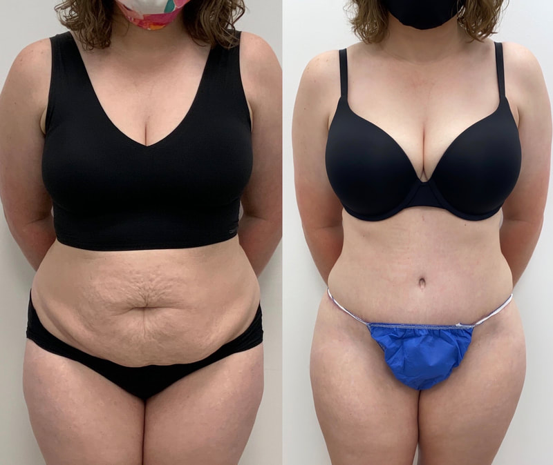 tummy tuck  - before & after 111