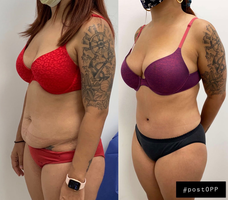 tummy tuck  - before & after 105