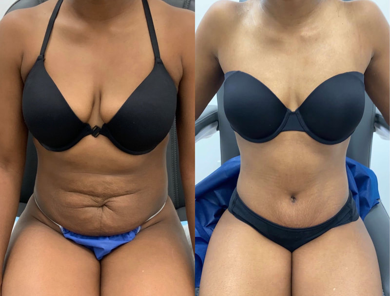 tummy tuck  - before & after 110